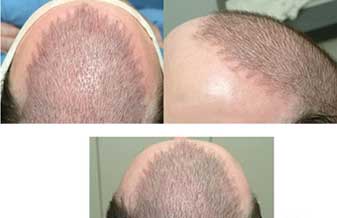 Derma Peel - Foto 1